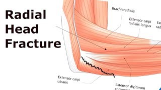 Radial Head Fracture  Medical Documentary [upl. by Brighton]