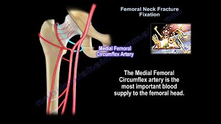 Femoral Neck Fracture Anatomy  Everything You Need To Know  Dr Nabil Ebraheim [upl. by Roseann838]