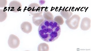 Folate Folic Acid amp Vitamin B12 Deficiency Macrocytic Anemia with Target Cells [upl. by Georgie]