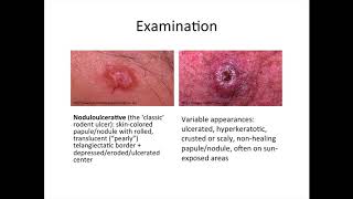 Basal Cell Carcinoma Shave Biopsy  Auburn Medical Group [upl. by Litsyrk]