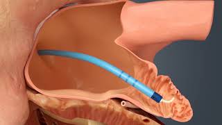 Getting an insertable cardiac monitor loop recorder Watch an implant procedure [upl. by Sasnett]