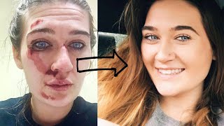 Pitted Acne Scar Makeup Tutorial Step by Step  Icepick ScarsBoxcar ScarsCraterspotmarks [upl. by Fulmer]