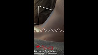 Normal Jugular Venous Pulse Narrated [upl. by Eirol]