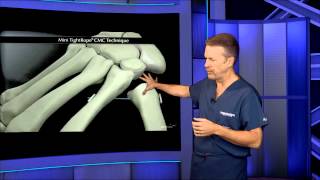 TMC Joint Replacement Surgery [upl. by Ann]