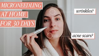 I Tried Microneedling at Home for 30 days before amp after  Deminuage Review [upl. by Nigem864]