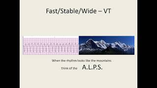 ACLS 2020 Algorithm Tachycardia [upl. by Herrod]