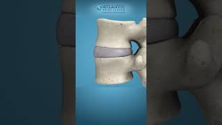 What is Lumbar Disc Herniation Shorts Atlantic Spine Center [upl. by Secnarf]