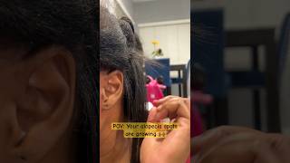 Alopecia Areata Treatment is Working alopeciahairloss alopecia [upl. by Hola]