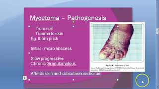 Microbiology 578 a Mycetoma foot Madurella mycetomatis Maduramycosis mycosis Eumycetoma Welsh regime [upl. by Audley]