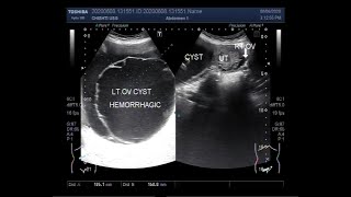 Treatment of Ovarian Cysts [upl. by Sidra]