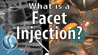 What is a Facet Injection [upl. by Rico]