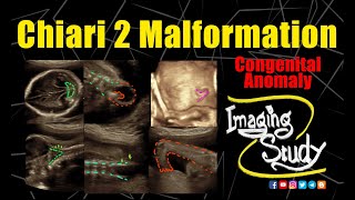 Chiari 2 Malformation  Ultrasound  Anomaly  Case 287 [upl. by Alistair342]