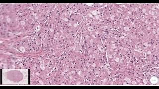 Granular cell tumor Breast  Histopathology [upl. by Eart]