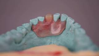 Valplast Flexible Denture [upl. by Aztiraj749]