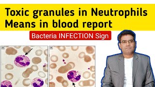 What is Toxic Granules in Neutrophils means in CBC Blood Report in hindi [upl. by Clarisa]