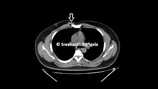 Sternalis Muscle  CT Chest [upl. by Koller454]