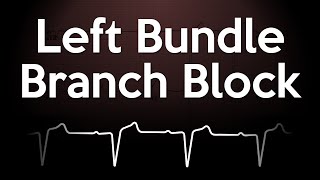 Left Bundle Branch Block ECG Explained [upl. by Salvucci]