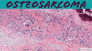 Osteosarcoma 101 Bone Pathology Basics [upl. by Klina]