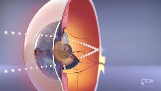 What is Orthokeratology or Ortho K [upl. by Neelrahs948]