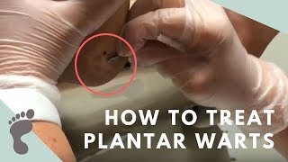 How To Treat Plantar Warts [upl. by Hogen542]