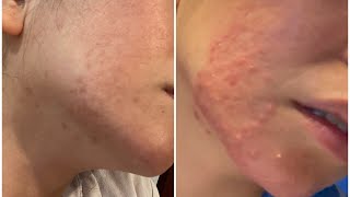 Lymecycline for Acne 3 Months Antibiotics  Weekly Vlogs [upl. by Ayeki]