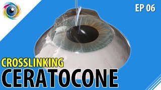 A cirurgia de crosslinking para o CERATOCONE EP06 CheckUp dos Olhos [upl. by Platto]