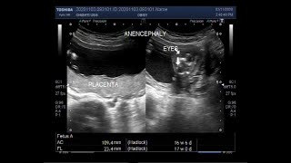 Ultrasound Video showing Anencephaly with a pregnancy of about 17 weeks [upl. by Akirehs]