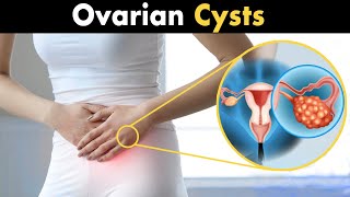 Ovarian Cyst Its Symptoms Diagnosis Causes and Treatment [upl. by Katrina453]