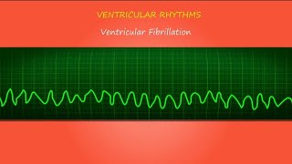 HOW TO identify Ventricular Tachycardia VT ampVentricular Fibrillation VF rhythms on an ECG strip [upl. by Lani]