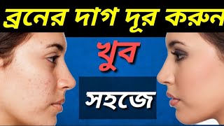 চিরতরে ব্রণের দাগ দূর করার সহজ উপায়  Broner Kalo Dag Dur Korar Bangla Health Tips bangla [upl. by Adrienne805]