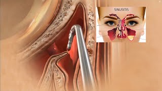 Sinus Surgery 3D Animation  Sinusitis Treatment  Sinus Operation [upl. by Juanita]