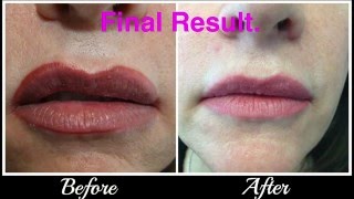 Lip tattoo CorrectionRemoval [upl. by Naves647]