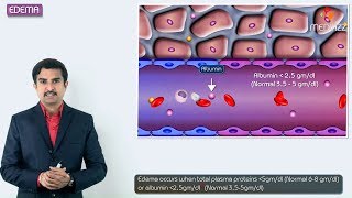 1Edema introduction  Hemodynamic pathology Fmge Neet PG and usmle [upl. by Cathie99]