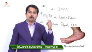 Edwards syndrome  Trisomy 18  Usmle quick review [upl. by Ahker]