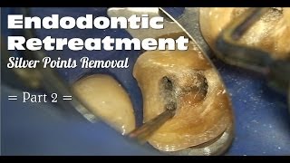 Endodontic Retreatment  Silver Points Removal Part 2 [upl. by Dupuy]