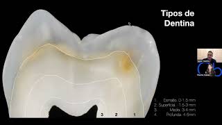 Tipos de Dentina adhesión y bases [upl. by Esor]