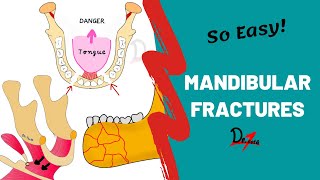 Mandibular Fractures  Basics  DENTAL NOTES [upl. by Bandler]