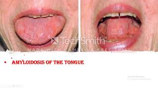 Amyloidosis Clinical course Symptoms and Signs Diagnosis and Prognosis of the disease [upl. by Schach]