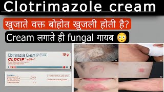 Clotrimazole cream review usesideeffectantifungal cream [upl. by Keppel]