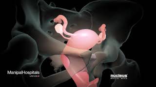 How Is A Robotic Hysterectomy Done  Robotic Hysterectomy Surgery  Gynaecology  Manipal Hospitals [upl. by Nonaihr]