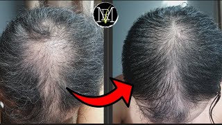 Microneedling for Hair Loss Results  Derma Pen vs Derma Roller [upl. by Cheshire758]