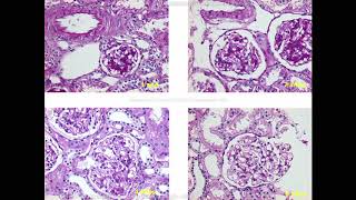 Histologia renal y patrones de lesión glomerular  Parte 1 [upl. by Rovit821]