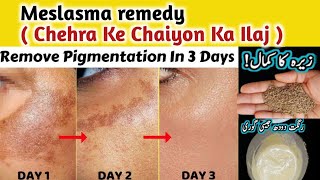 Hyperpigmentation Treatment  Chaiyon Ka Ilaj  Glowing Skin Home Remedy  Melasma  Pakistan Life [upl. by Roxanne]