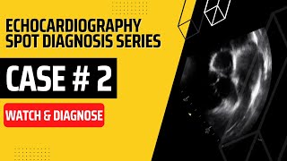 Case 2 Echocardiography Spot Diagnosis Case Series  Watch amp Diagnose  Learn Echo Findings  TOACS [upl. by Evans]