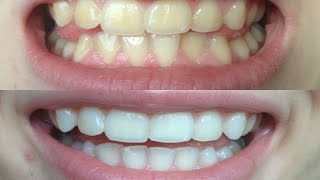 How I whitened my VERY yellow teeth WORKS BEFORE AND AFTER [upl. by Rhines]