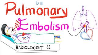 Pulmonary Embolism PE [upl. by Cornall]