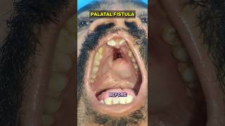 Large Palatal Fistula Closure  By Most Experience Cleft Surgeon  Dr Parit Ladani [upl. by Seugram803]