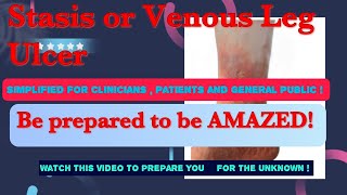 Venous Leg Ulcer Stasis Ulcer  Understanding the cause  treatment and selfmanagement [upl. by Eneleuqcaj]