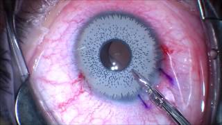 Want to change your eye color Think twice Iris Implant Removal JT Kavanagh MD San Antonio TX [upl. by Googins]