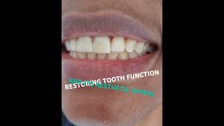 Chipped tooth Get a dental filling  House of Dentistry  Westlands Nairobi [upl. by Enowtna994]